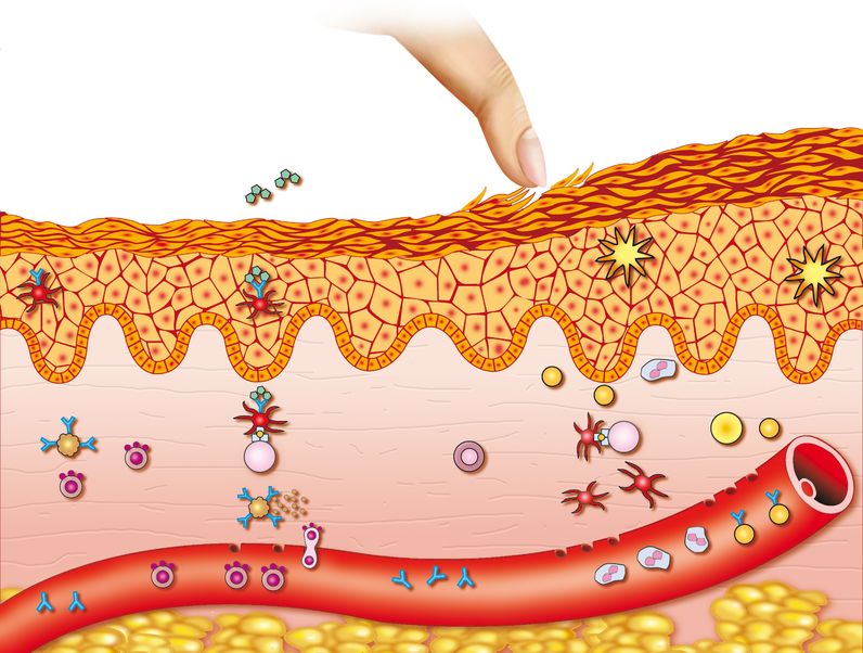 ¿Cuáles son las causas del eczema?
